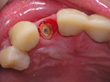 Dr. Schoonover -- Bone Graft, Mini Implant and Crown (Before)