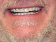 Dr. Schoonover -- Bone Graft, Mini Implant and Crown (After)