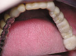 Dr. Schoonover -- Mini-Implant Crowns (After)