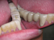 Dr. Schoonover -- Mini-Implant Crowns (After)