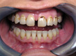 Dr. Schoonover -- Cosmetic Bonding Before