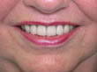 Dr. Schoonover -- Mini Implant Dentures