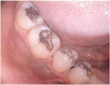 Dr. Schoonover -- Fillings