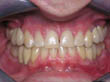 Dr. Schoonover -- Implant Crowns (After)