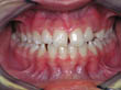 Dr. Schoonover -- Orthodontics (Before)