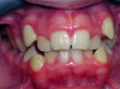 Dr. Schoonover -- Orthodontics (Before)