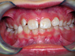 Dr. Schoonover -- Orthodontics (Before)