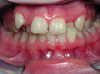 Dr. Schoonover -- Orthodontics (Before)